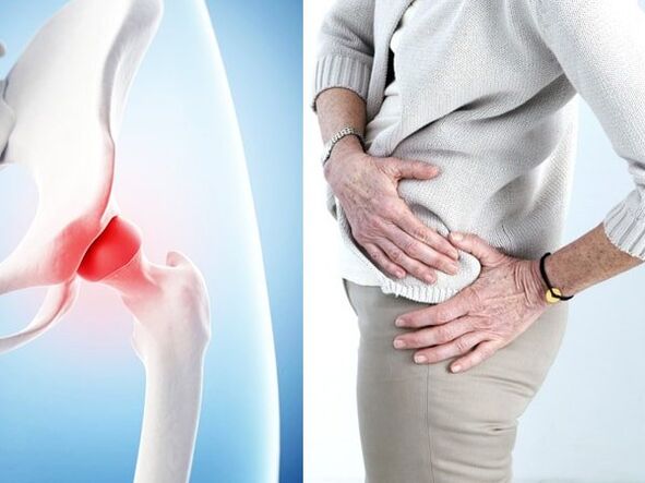 deformirajuća artroza akutne boli u koljenu