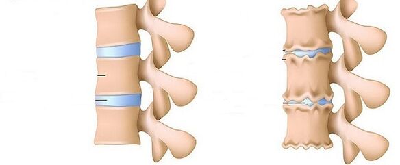 uređaji za liječenje artroze i zglobova liječenje artroze koljena fizioterapijom