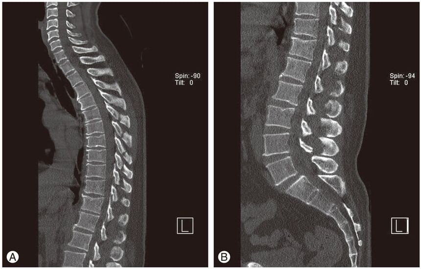 Deformacija intervertebralnih diskova na MRI slikama u torakalnoj osteokondrozi