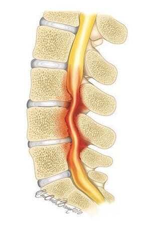 Kod osteohondroze torakalne kralježnice dolazi do kompresije kralježničnog kanala