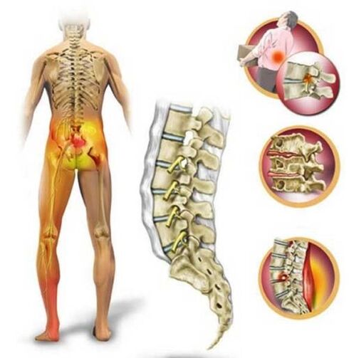 Osteokondroza lumbalne kralježnice, koja uzrokuje bolove u leđima