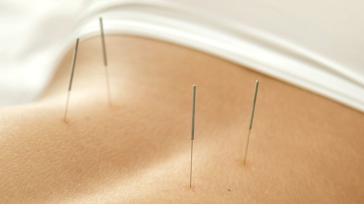 Akupunktura će vam pomoći da se riješite bolova u donjem dijelu leđa